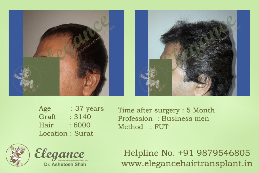 FUT  Hair Transplant Cost Valsad, Gujarat, india