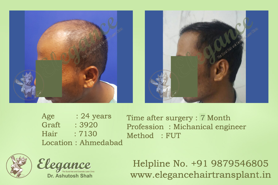 FUT Hair Transplant Cost Vapi, Gujarat, india