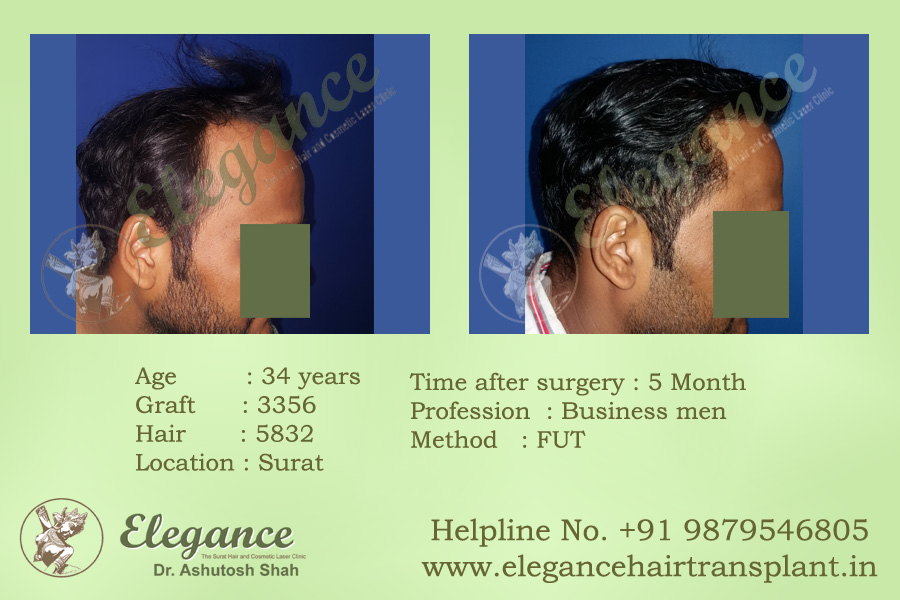 FUT Hair Transplant Procedure Ankleswar, Gujarat, india