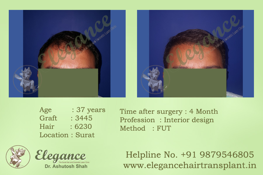 FUT Hair Transplant Procedure Valsad, Gujarat, india