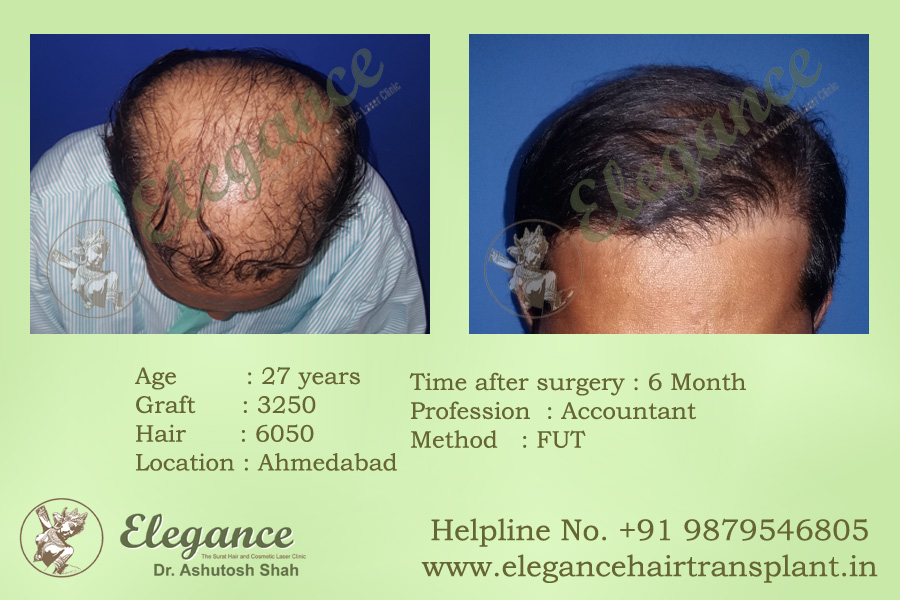 FUT Hair Transplant Procedure Vapi, Gujarat, india