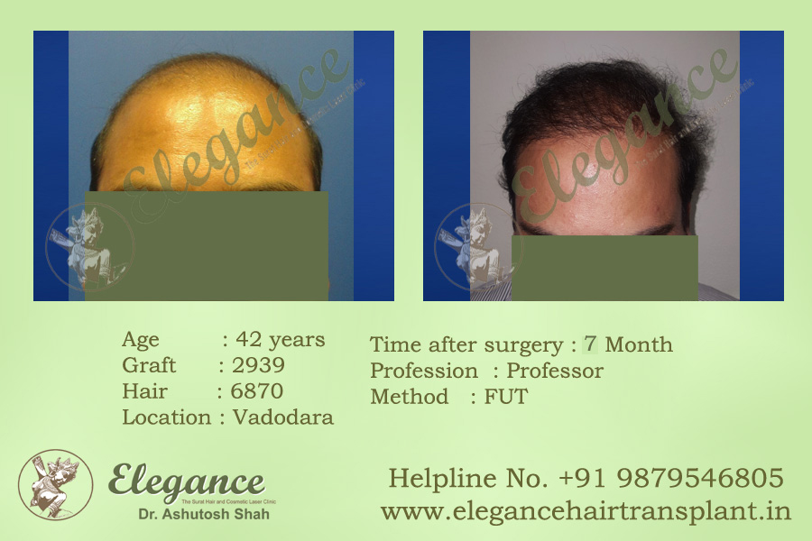 FUT Hair Transplant Results Ankleswar, Gujarat, india