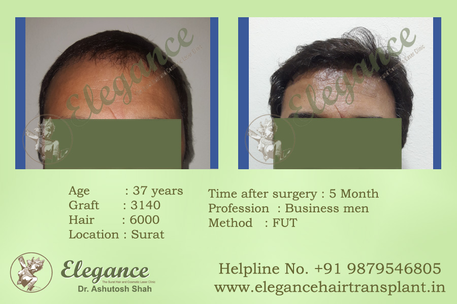 FUT Hair Transplant Results Valsad, Gujarat, india