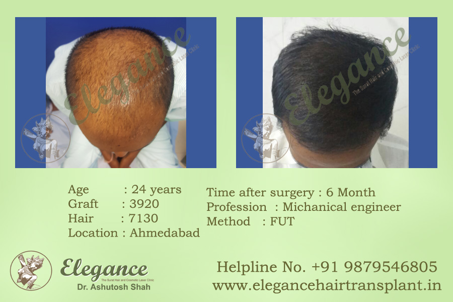 FUT Hair Transplant Results Vapi, Gujarat, india