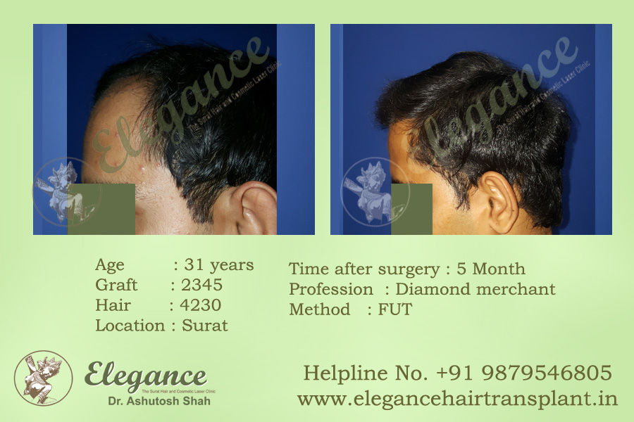 Hair Clinic in Ankleswar, Gujarat, india