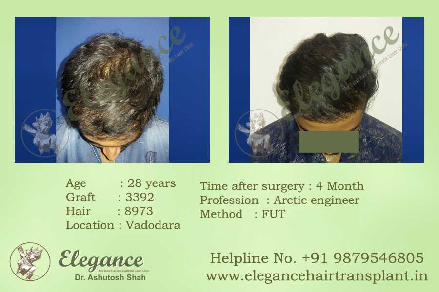 Hair Replacement in Ankleswar, Gujarat, india