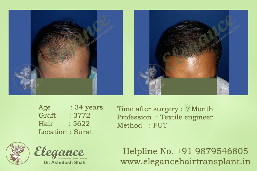 Hair Replacement in Valsad, Gujarat, india