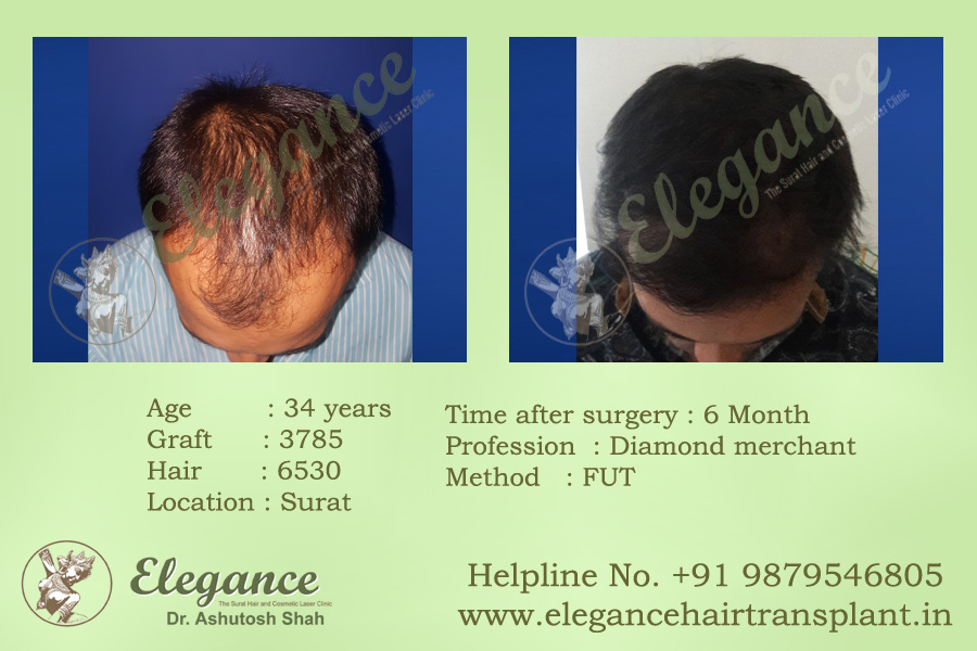 Hair Transplant Clinic in Ankleswar, Gujarat, india