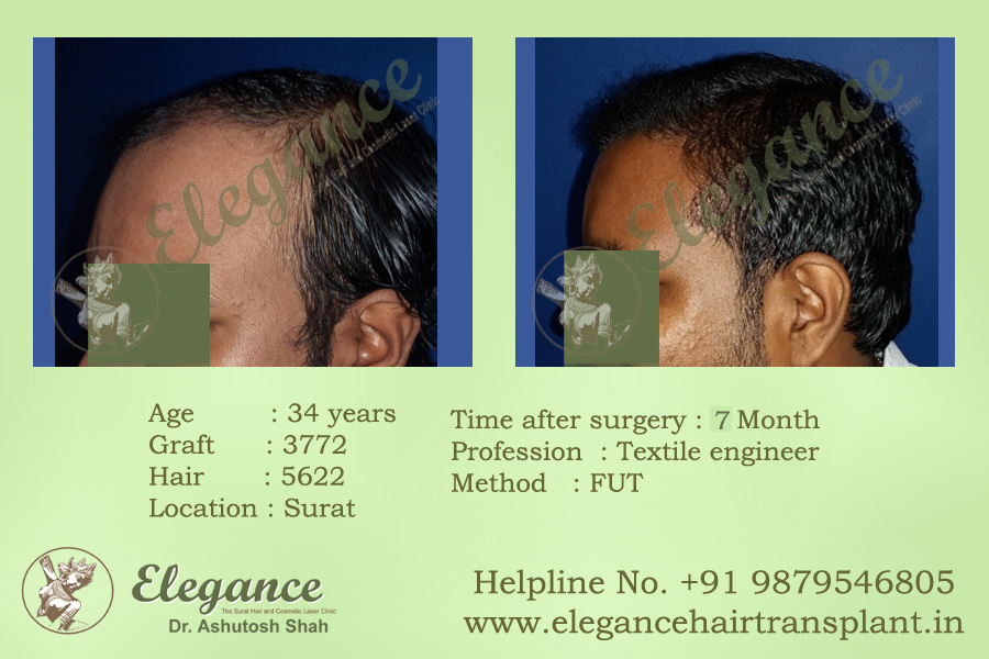Hair Transplant Clinic in Valsad, Gujarat, india
