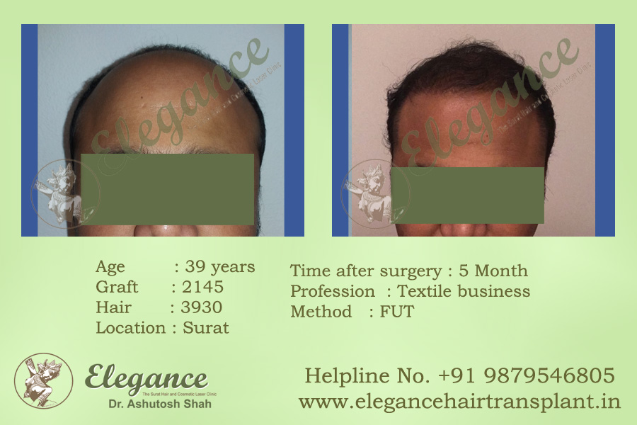 Hair Transplant Cost in Ankleshwar, Gujarat, india