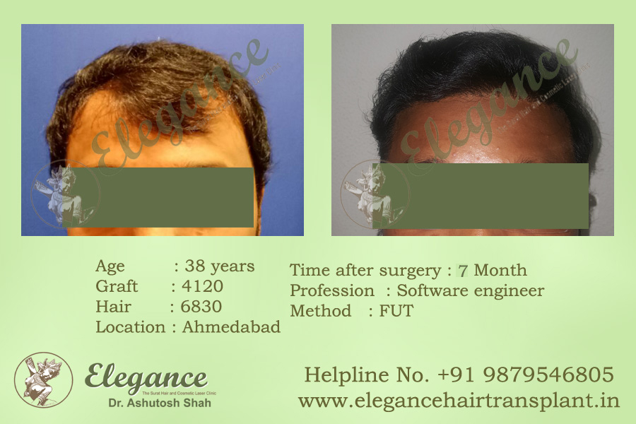 Hair Transplant Cost in Valsad, Gujarat, india