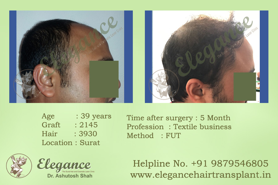Hair Transplant in Ankleshwar, Gujarat, india