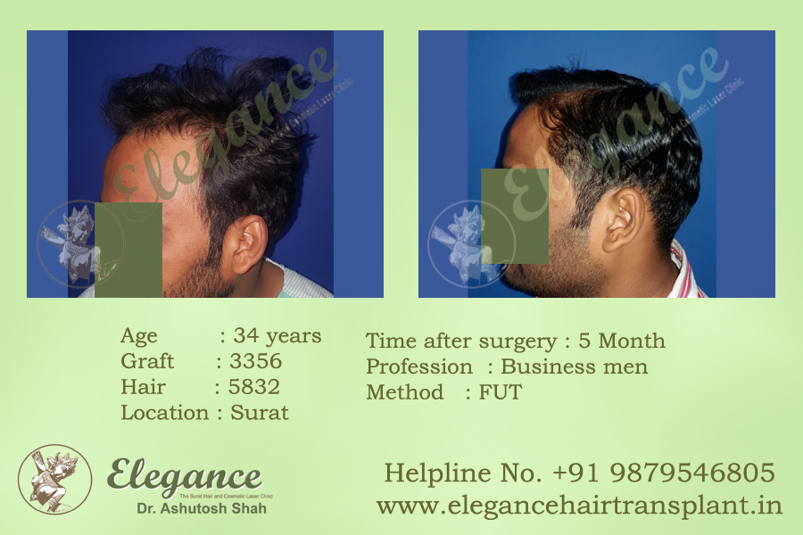Hair Transplant in Valsad Price