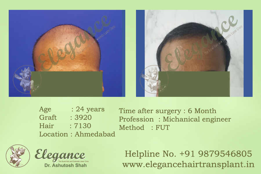 Hair Transplant Results Valsad, Gujarat, india