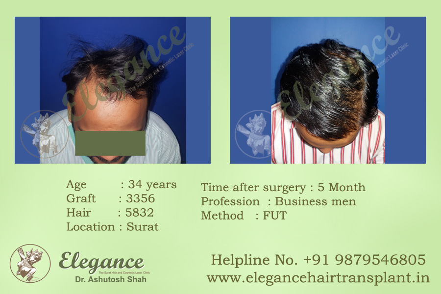 Valsad, Gujarat, india Hair Transplant Clinic