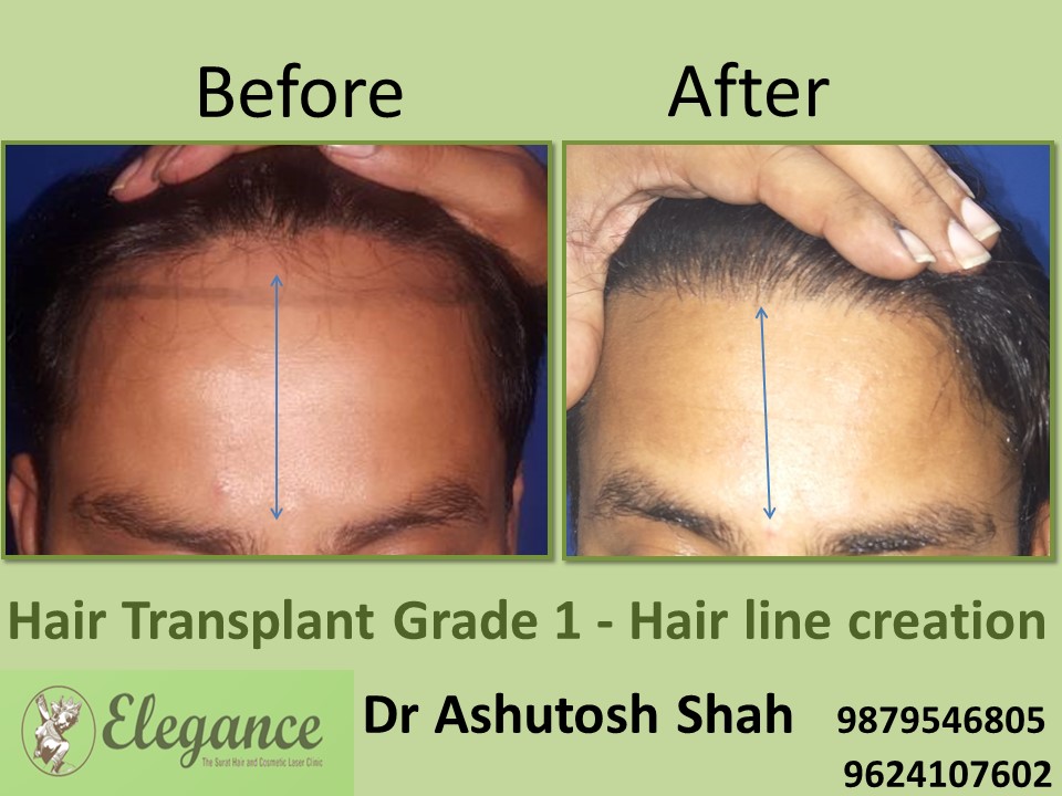 Grade 1 Hair Line Creation Result In Pune, Maharashtra, India