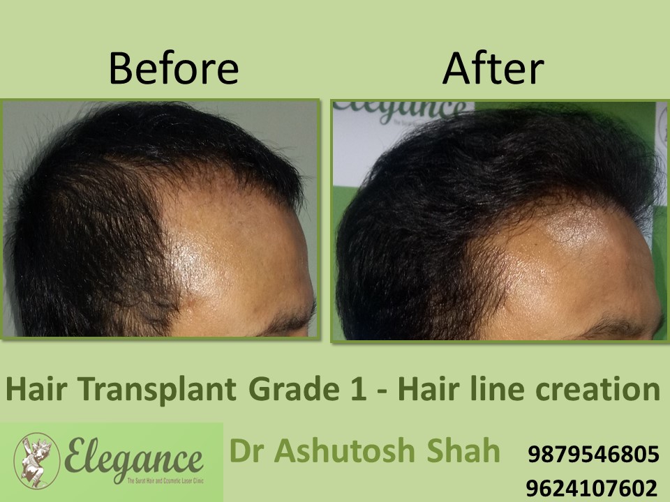 Grade 1 Hair Line Creation Result In Delhi, India
