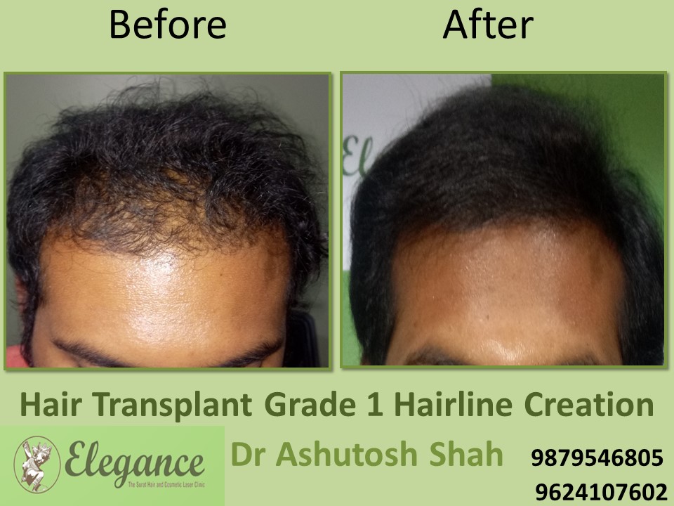 Grade 1 Hair Line Creation Result In Udaipur, Rajasthan, India