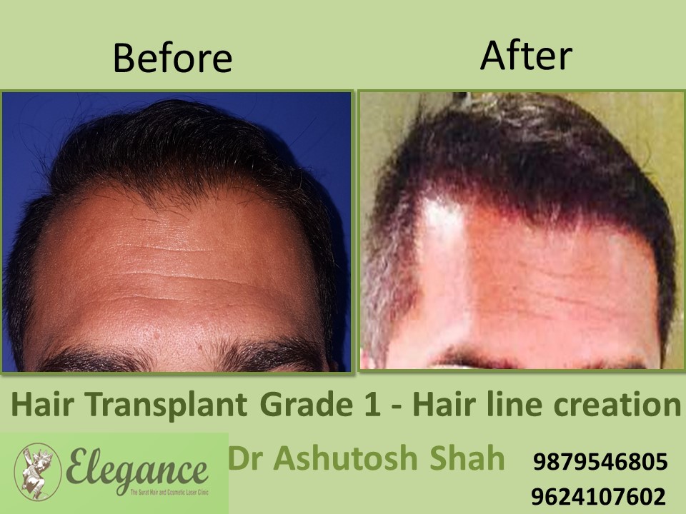 Grade 1 Hair Line Creation Doctor In Surat, Gujarat, India