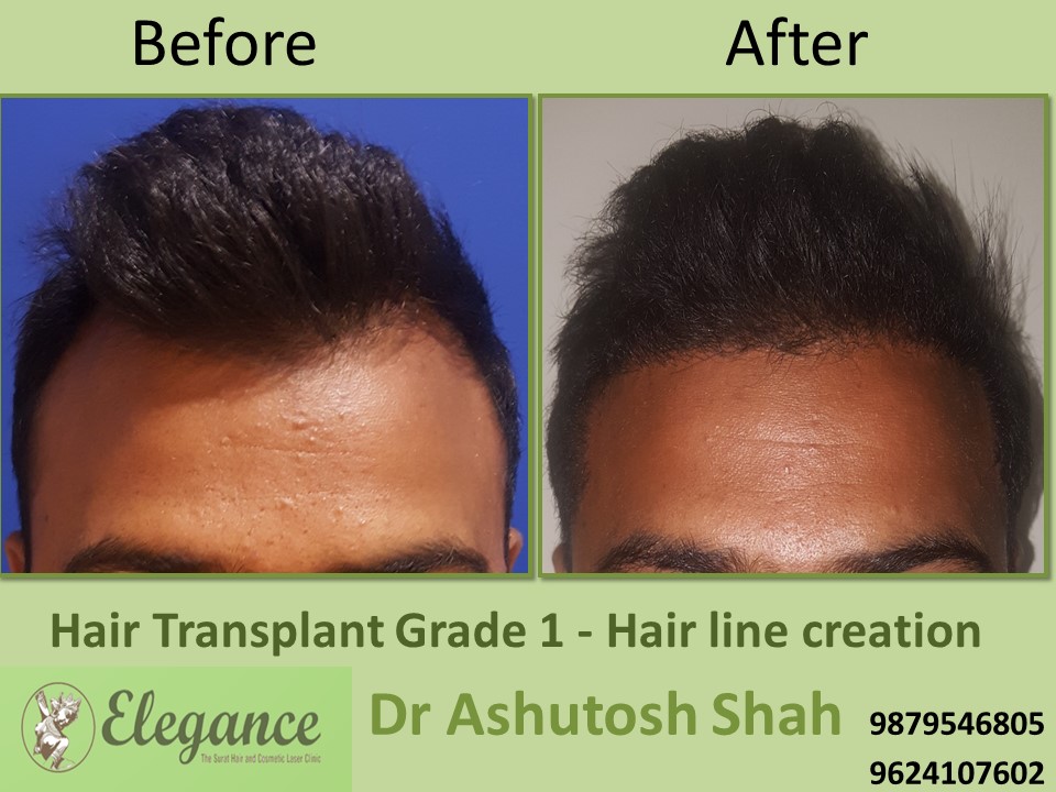Grade 1 Hair Line Creation Cost In Surat, Gujarat, India