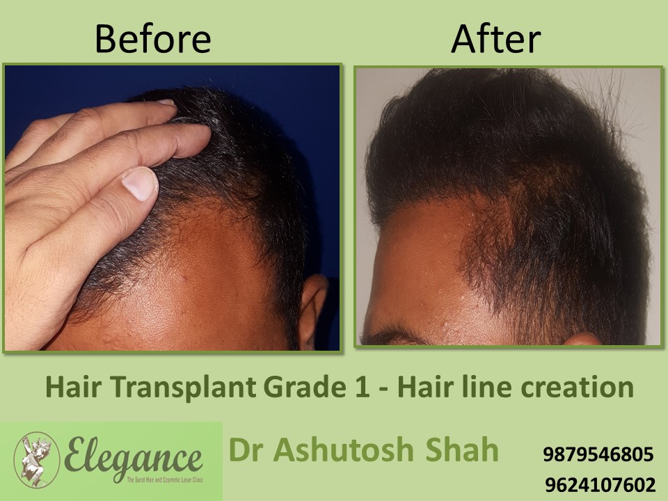 Grade 1 Hair Line Creation Treatment In Surat, Gujarat, India