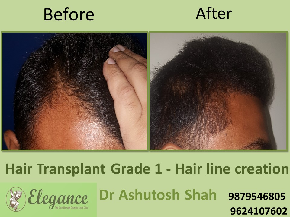 Grade 1 Hair Line Creation Surgery In Surat, Gujarat, India