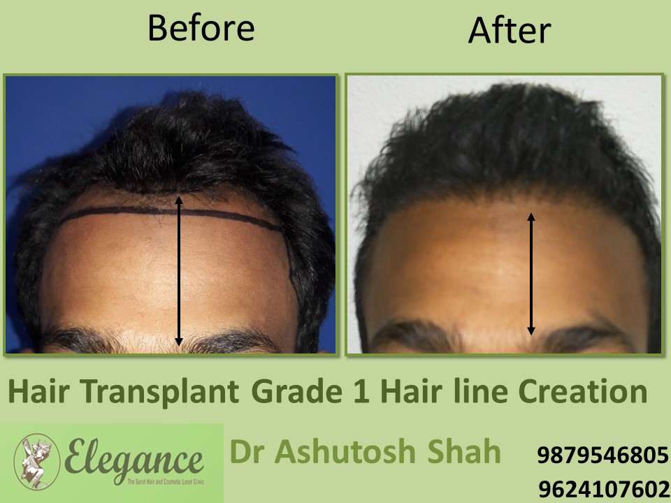Grade 1 Hair Line Creation Result In Surat, Gujarat, India