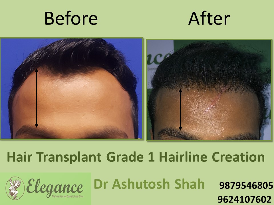 Grade 1 Hair Line Creation Result In Hyderabad, Telangana, India