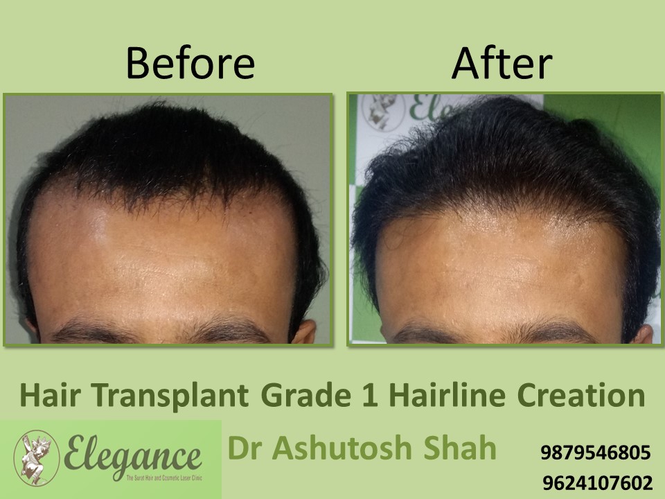 Grade 1 Hair Line Creation Result In Mumbai, Maharashtra, India