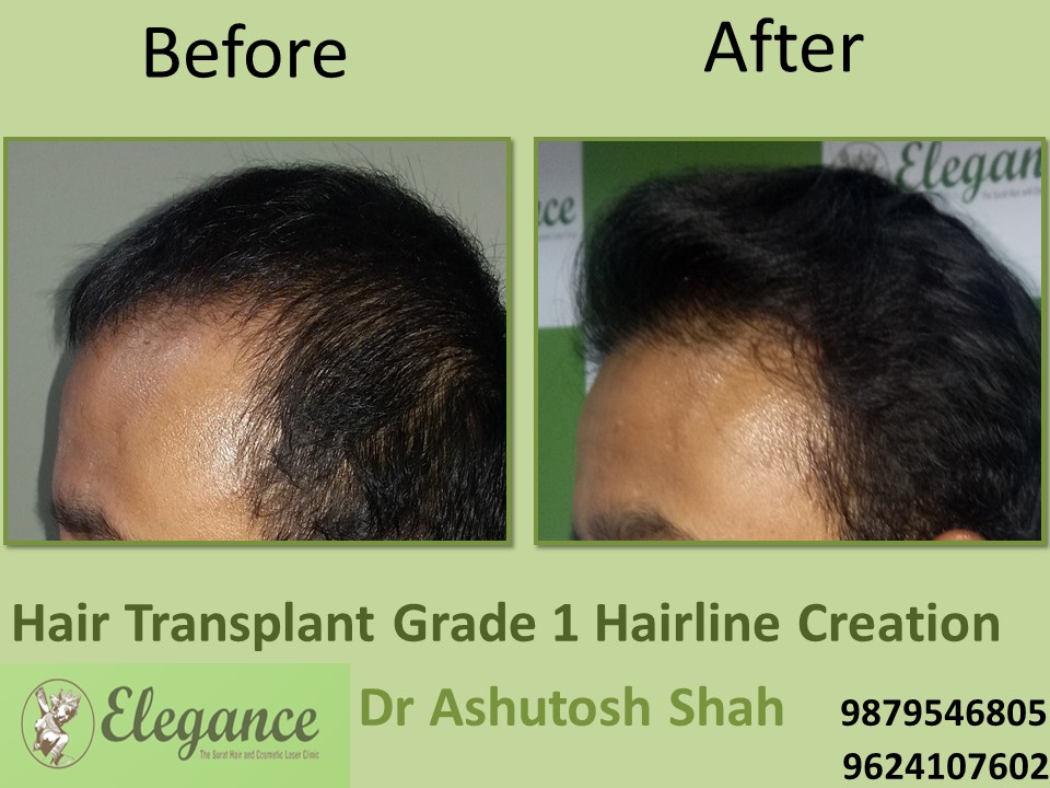 Grade 1 Hair Line Creation Result In Bengaluru, Karnataka, India