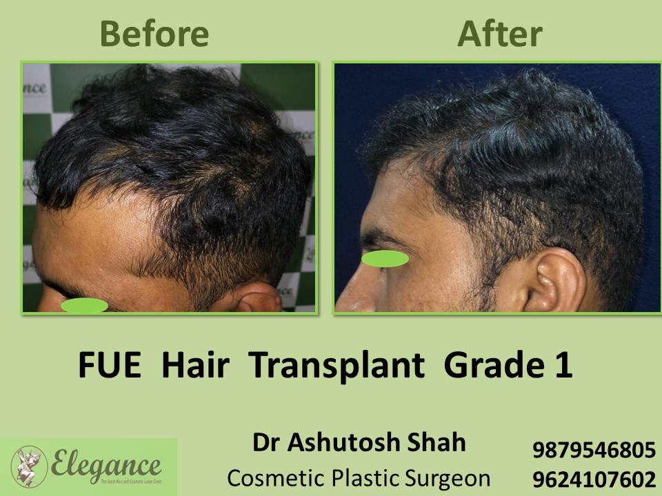 FUE Hair Transplant, Grade 1, Hair Growth in Vesu, Surat