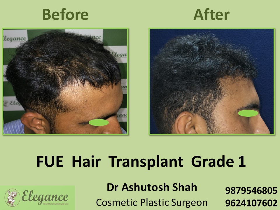 Hair Transplant, Hair Regrowth, Grade 1  Treatment in Surat