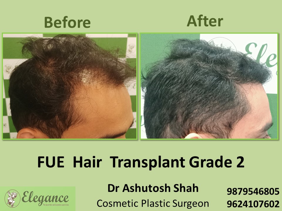 Grade 2, FUE Method, Hair Transplant in  Vesu, Surat