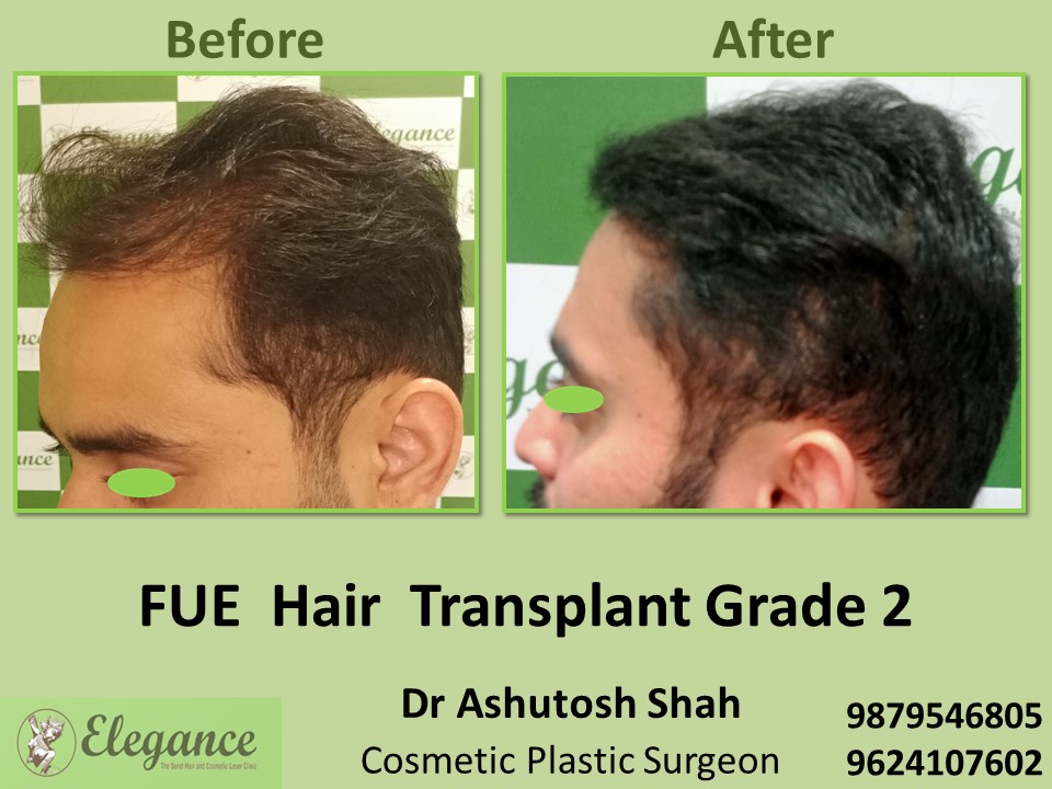 Hair Baldness, FUE Method Treatment in Adajan, Surat