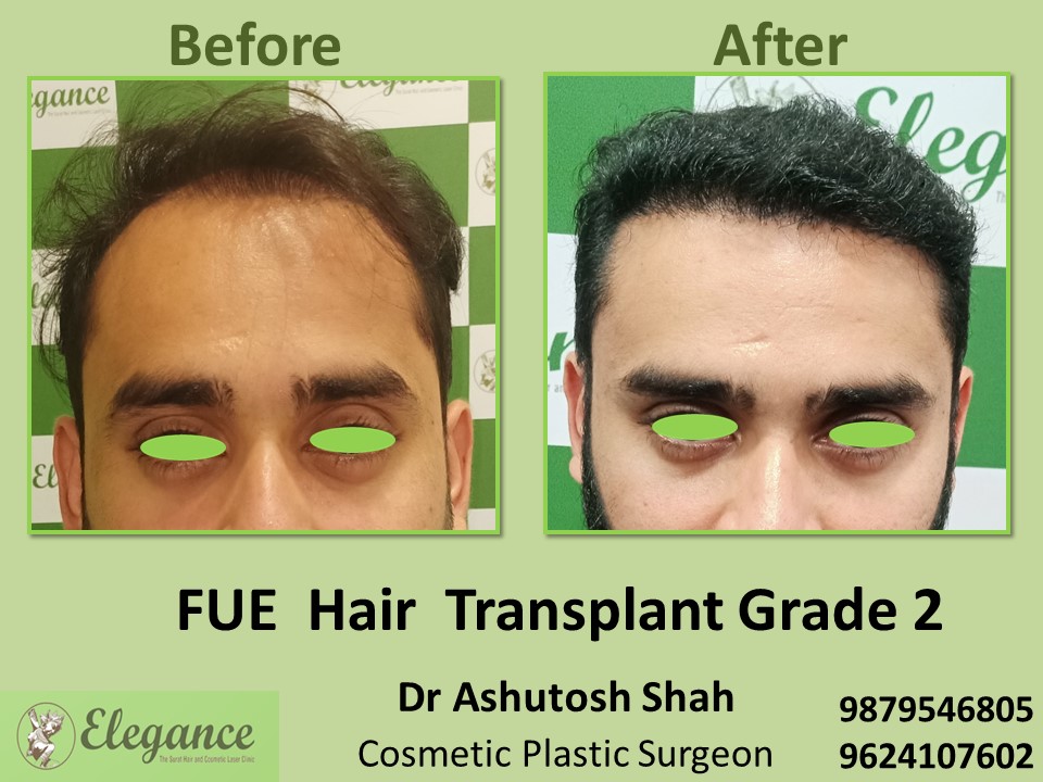 Hair Density Treatment, FUE Hair Transplant Grade 2 in Adajan, Vesu, Surat