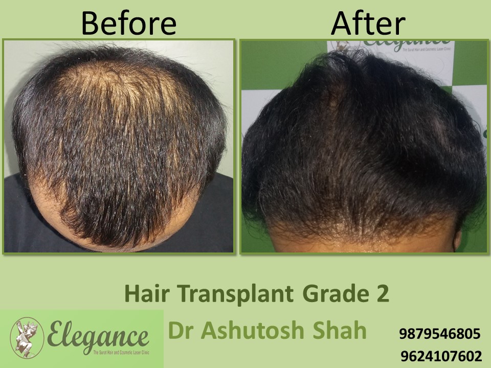 Grade 2 Hair Transplant In Surat, Gujarat, India