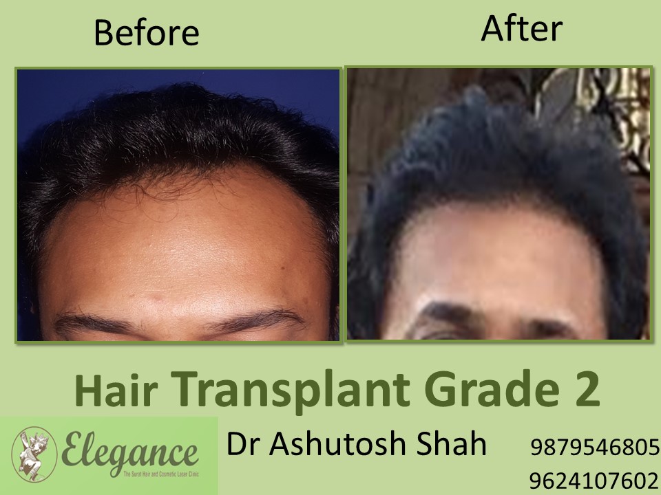Grade 2 Hair Transplant Cost In Surat, Gujarat, India