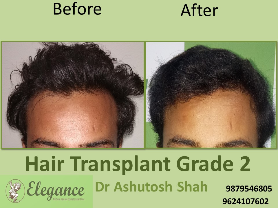 Grade 2 Hair Transplant Doctor In Surat, Gujarat, India