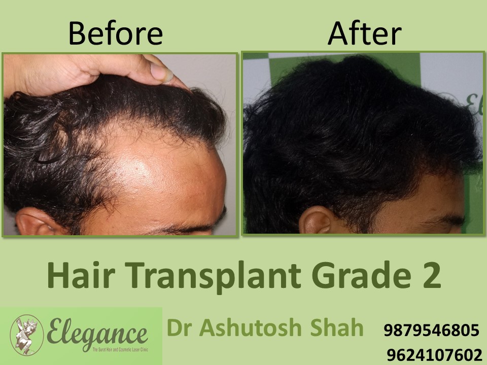 Grade 2 Hair Transplant Before And After In Vapi, Gujarat, India