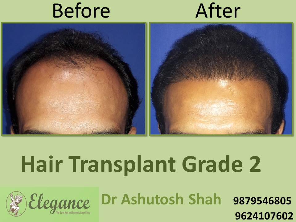 Grade 2 Hair Transplant In Valsad, Gujarat, India