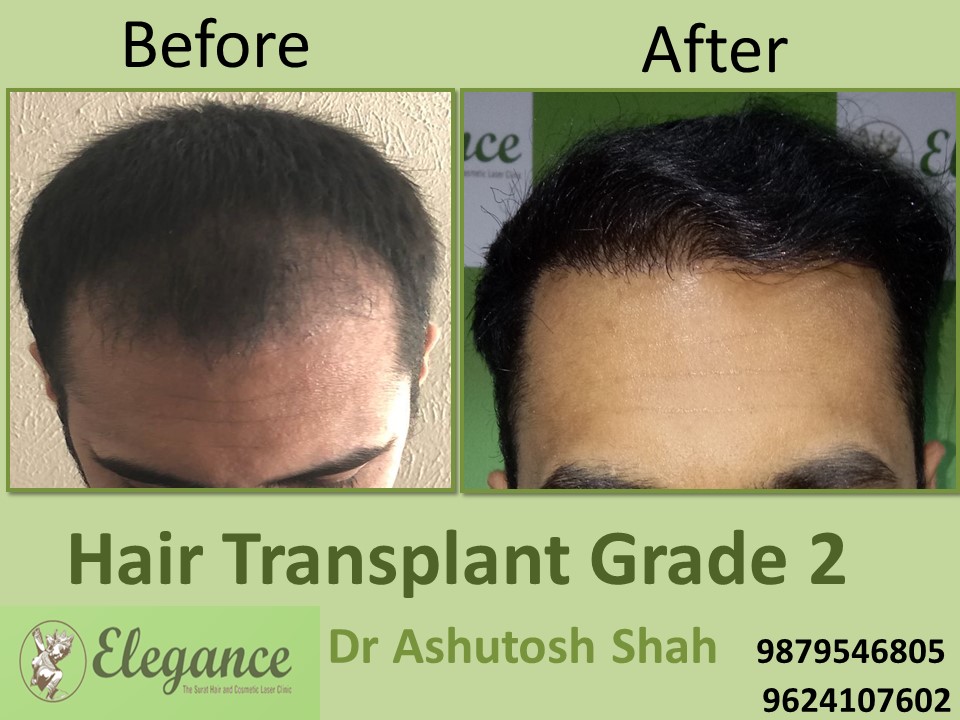 Grade 2 Hair Transplant In Diu, Gujarat, India