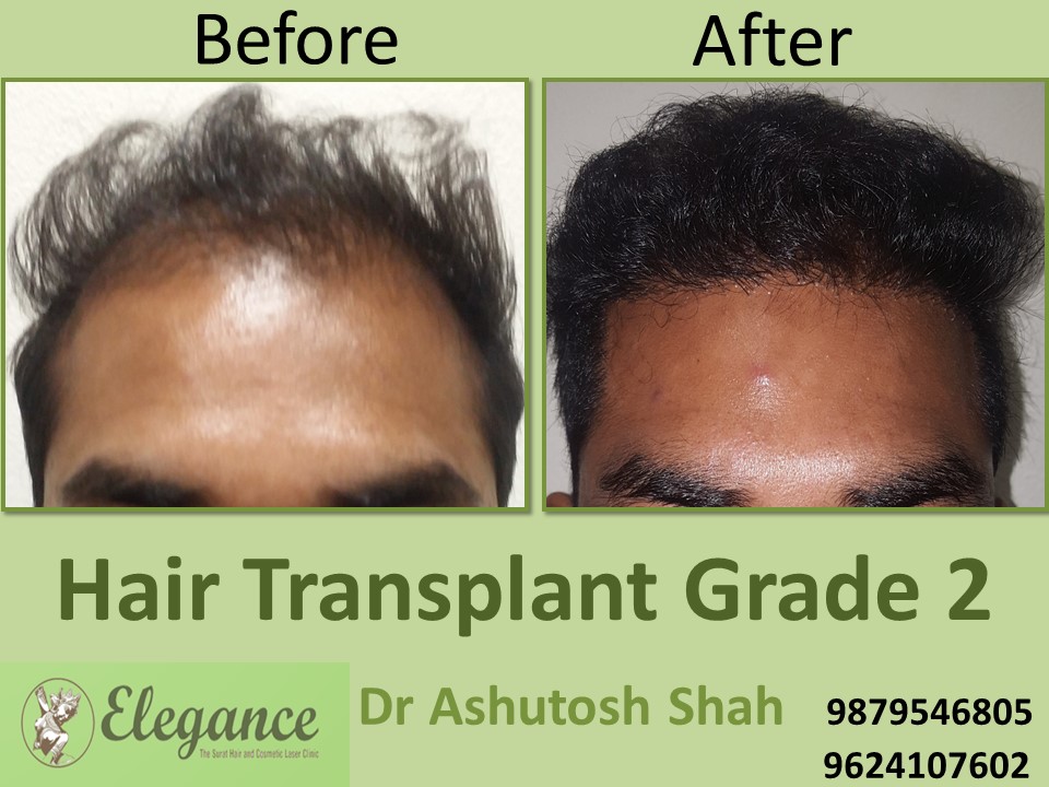 Grade 2 Hair Transplant In Rajkot, Gujarat, India