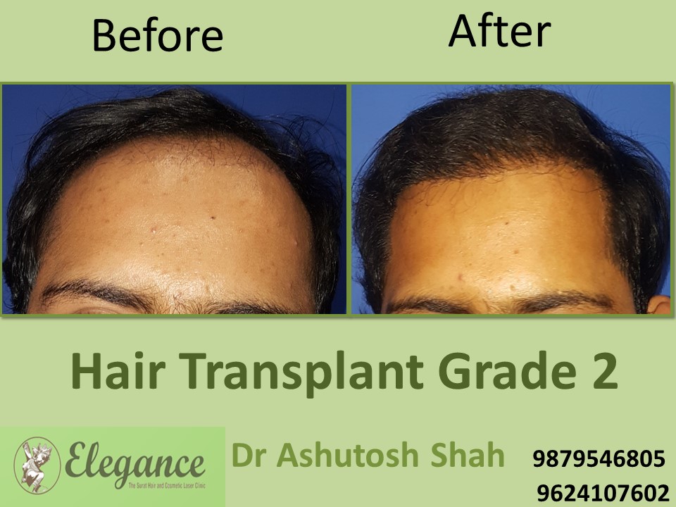 Grade 2 Hair Transplant In Amreli, Gujarat, India