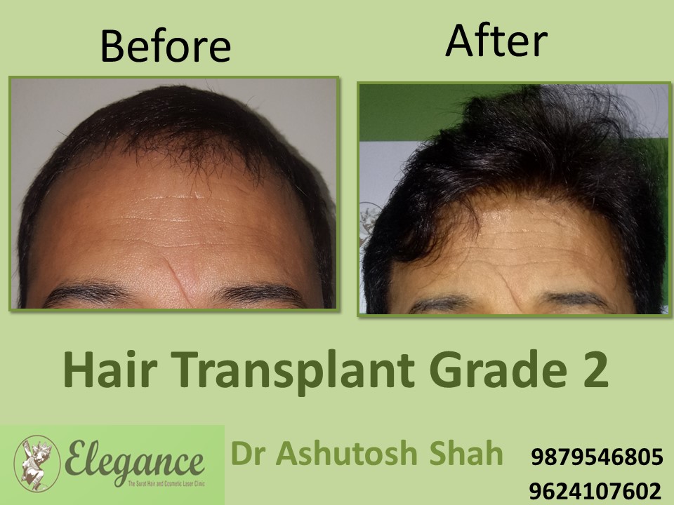 Grade 2 Hair Transplant In Bhuj, Gujarat, India