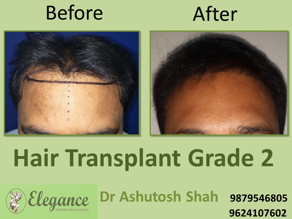 Grade 2 Hair Transplant In Botad, Gujarat, India