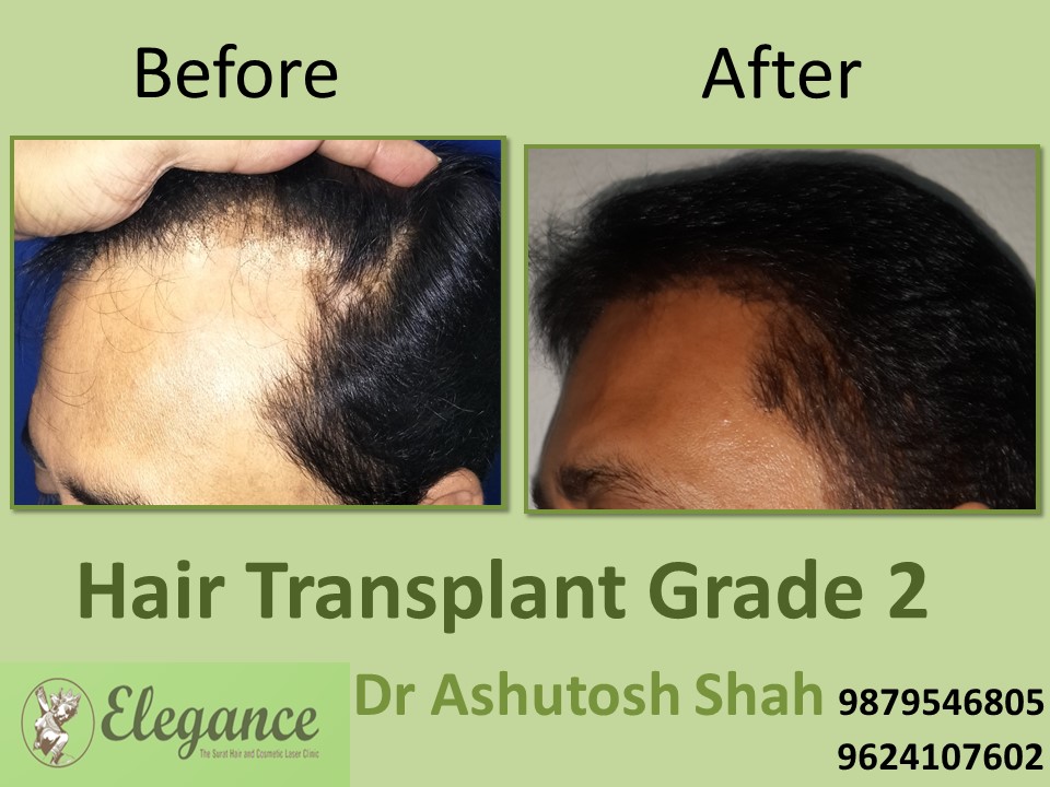 Grade 2 Hair Transplant In Patna, Bihar, India