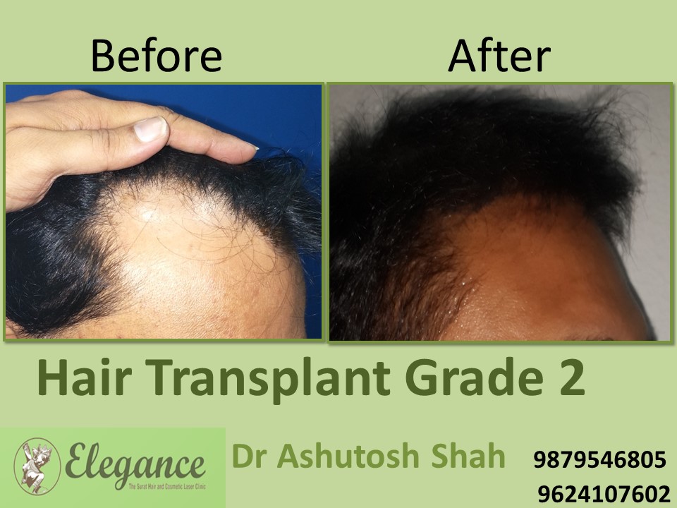 Grade 2 Hair Transplant In Lucknow, Uttar Pradesh, India