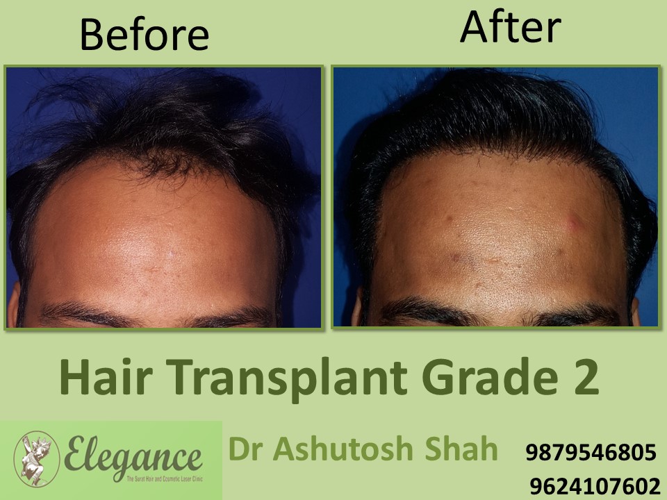 Grade 2 Hair Transplant In Agra, Uttar Pradesh, India