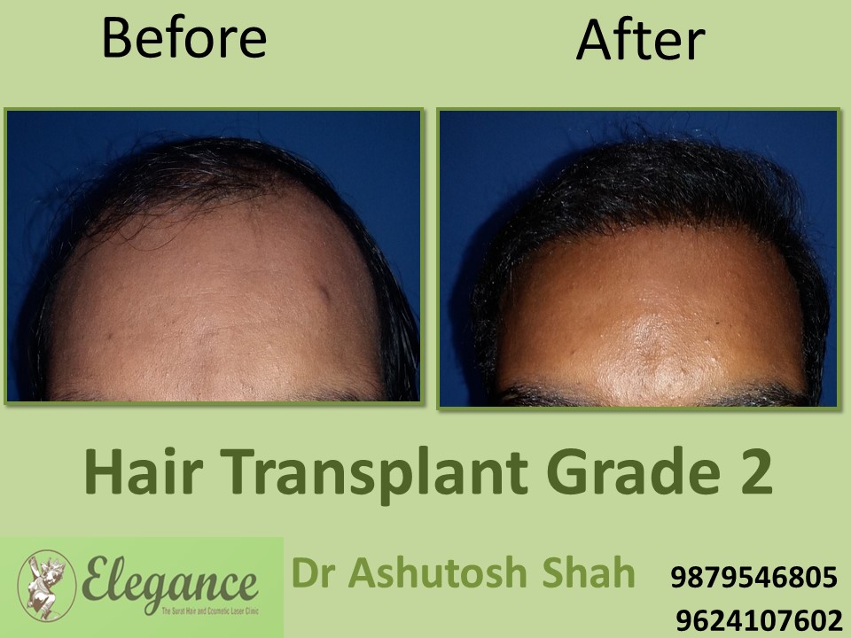 Grade 2 Hair Transplant In Ajmer, Rajasthan, India