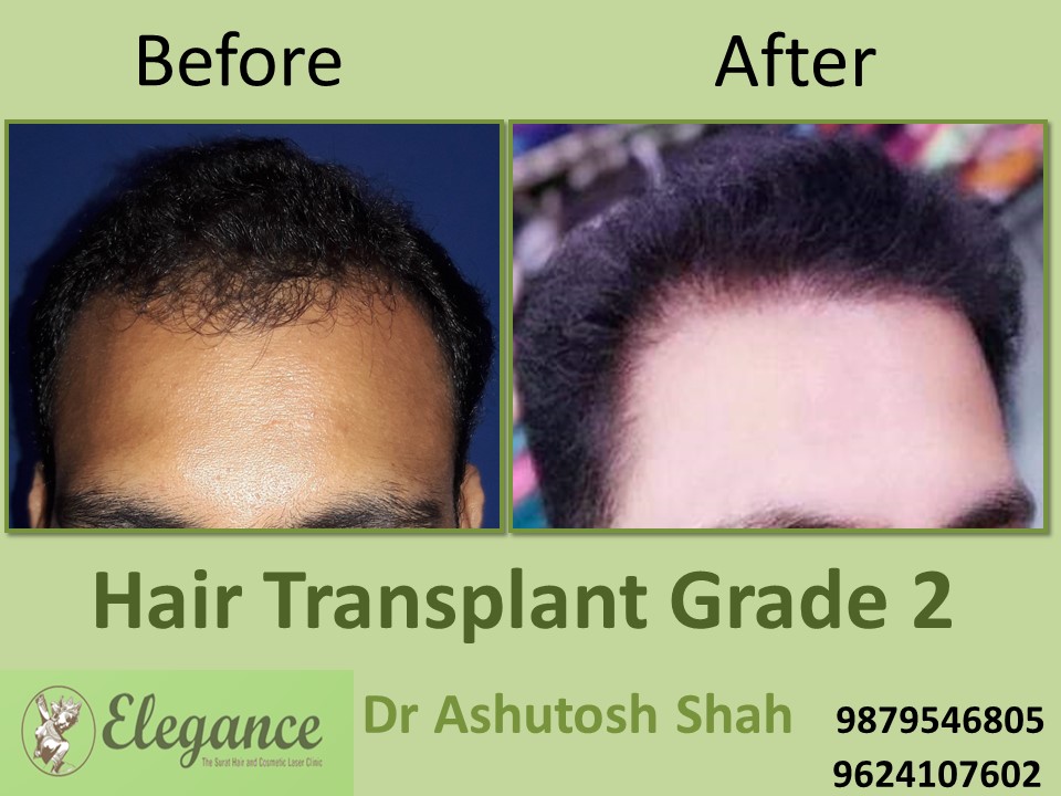 Grade 2 Hair Transplant In Jodhpur, Rajasthan, India